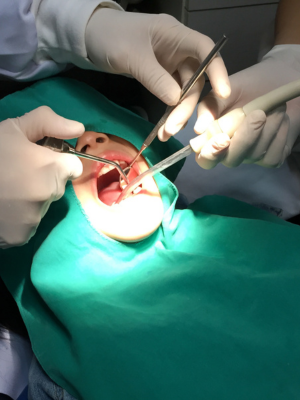 Sutures for dental surgery
